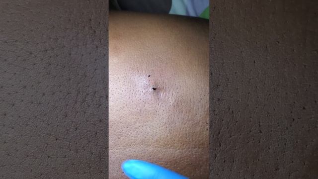 Another Huge Back Blackhead Squeeze