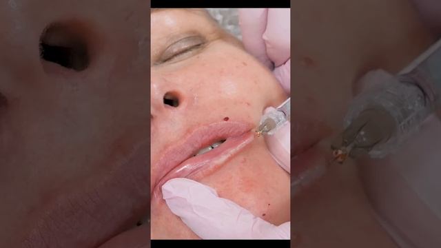 Коррекция контура губ и восполнение объема