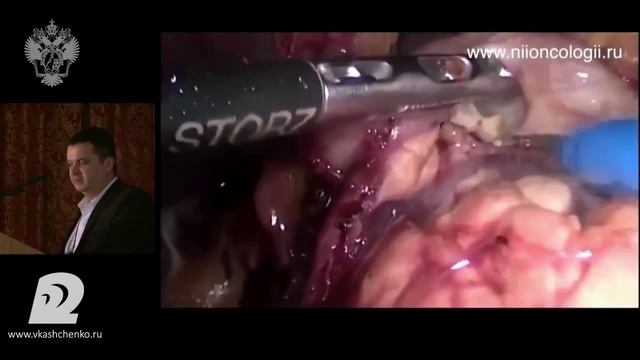 Карачун Техника лимфодиссекции смотреть онлайн