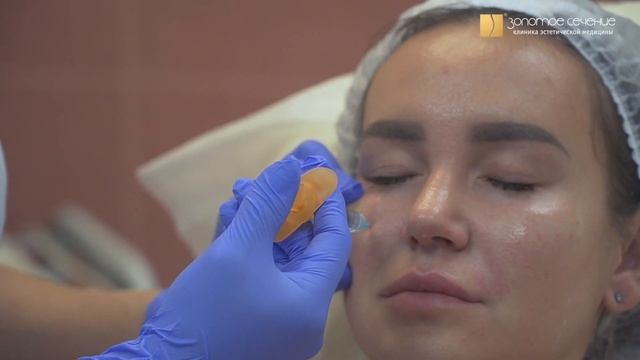 Моделирование скул и контурная пластика подбородка филлером. Результат сразу после процедуры смотреть онлайн