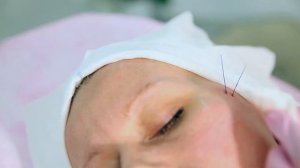 Как убрать носогубные складки, Подтяжка овала лица, Нитевой лифтинг, Нити с насечками