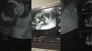 УЗИ 19 недель( второй скрининг)10.08.21