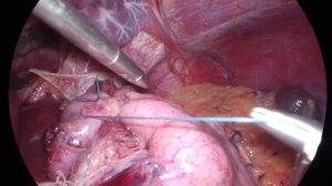 Грыжа пищеводного отверстия диафрагмы. Лапароскопическая фундопликация.