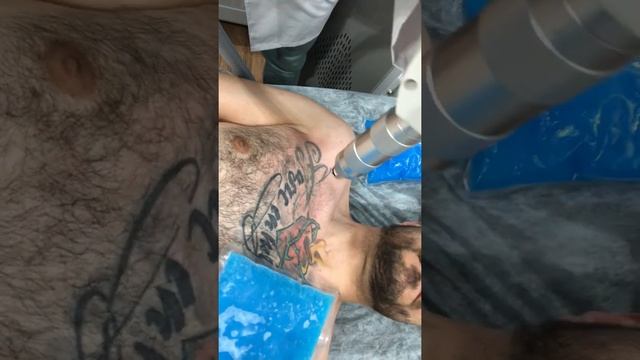 Удаление татуировки смотреть онлайн