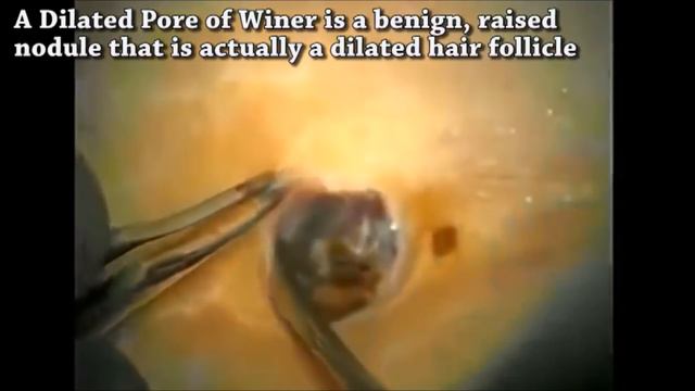 DPOW Vs Pimple Popping