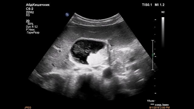 Ультразвуковая картина рака желчного пузыря смотреть онлайн
