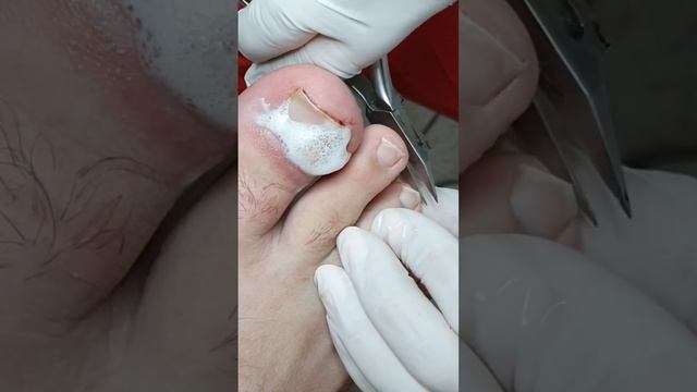 Вросший ноготь работа подолога с вросшим ногтем смотреть онлайн