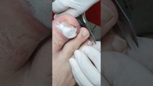 Вросший ноготь работа подолога с вросшим ногтем