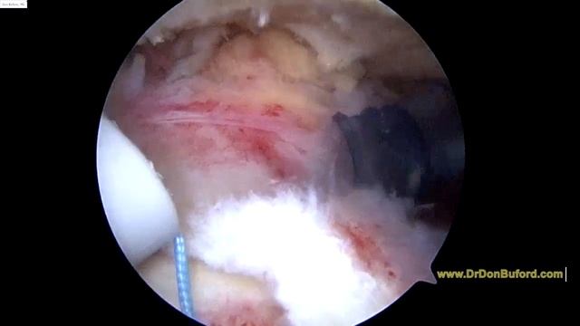 L Shoulder Rotator Cuff Repair And Biceps Tenodesis 2018 11 12 KD