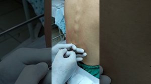 Спинальная(субдуральная) анестезия.