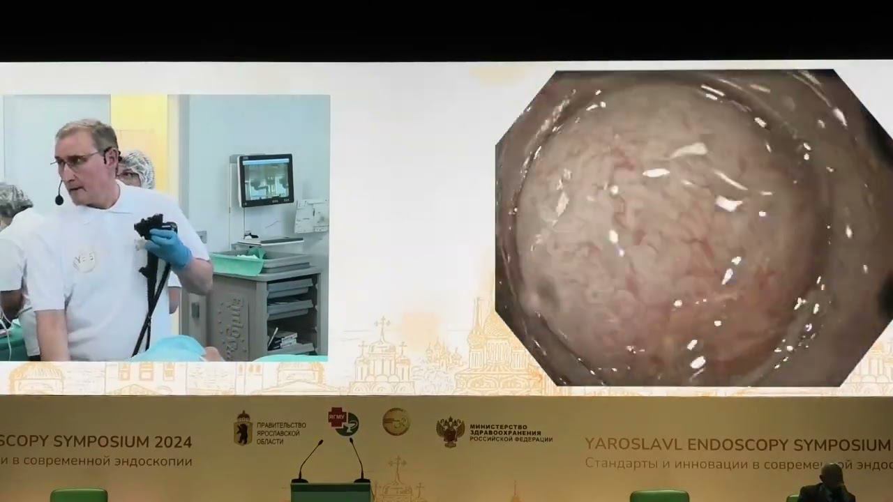 2024 06 21 Live12 Кашин СВ Пищевод Барретта Гибридная Аргон Плазменная абляция