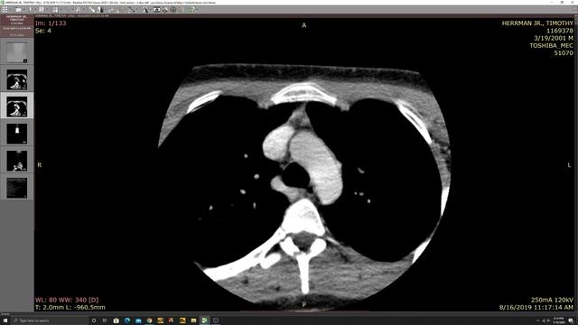 Talking about the most difficult 3 months of my life. | Enlarged Posterior Triangle Lymph Nodes смотреть онлайн