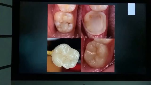 Вебинар часть 2 Вебинар по ортопедической стоматологии смотреть онлайн