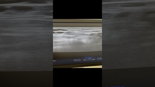 Варикоз на голени у парня. Лечение варикоза. Узи вен. Флеболог. Флеболог Москва. Сосудистый хирург смотреть онлайн