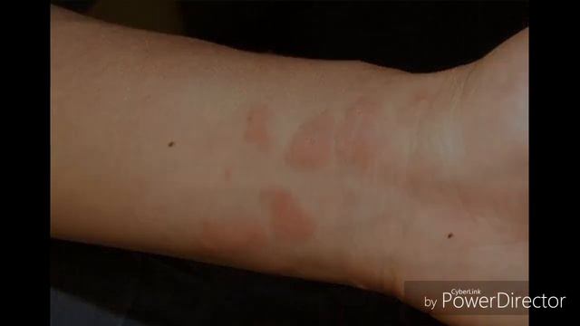 Eshakem Kasalligi Haqida Эшакем касаллиги ҳақида