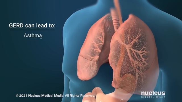 What Causes GERD? смотреть онлайн