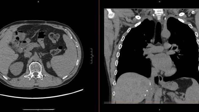 Lymph Nodes смотреть онлайн