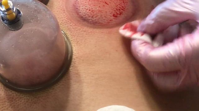 Хиджама, снимаем банку смотреть онлайн