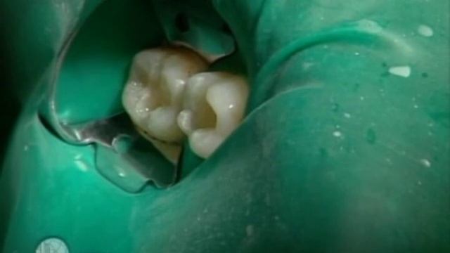 2 Реставрация с использованием СИЦ лайнерная подкладка и композита смотреть онлайн