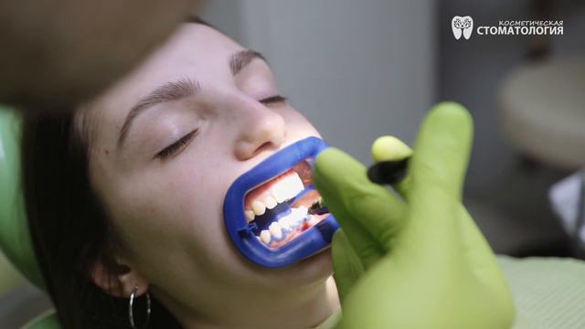 Отбеливание Philips ZOOM White Speed / ZOOM 4 - Д-р Ирина Барциковская. Косметическая Стоматология