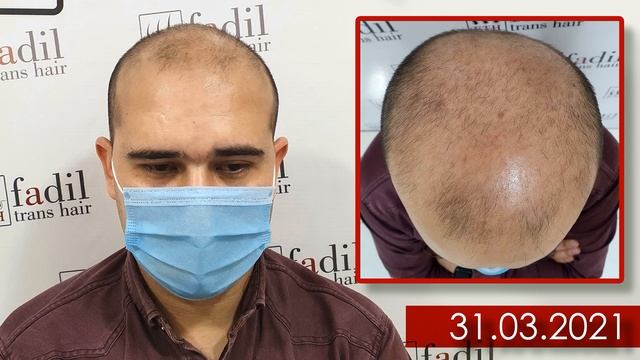 VII - степень алопеция | Иккинчи этап смотреть онлайн