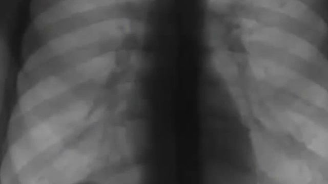 Флюорографию нужно делать не менее одного раза в год смотреть онлайн