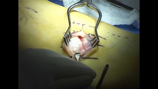 Dr. Gruber Ligament Reconstruction of the Ankle смотреть онлайн