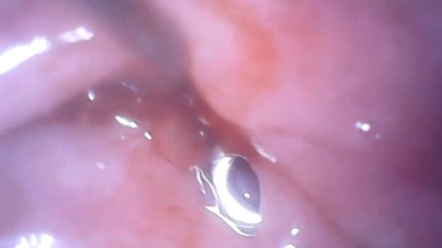 Tonsil Stone Tuesday! - July 20 - Blood warning! смотреть онлайн