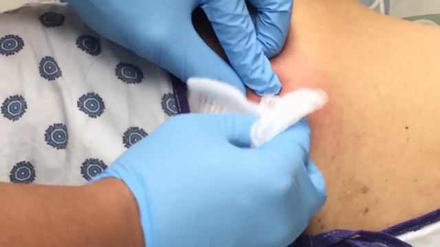 PIMPLE POPPING ON BACK PART6 Of 8