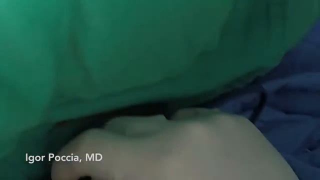 MICROSURGERY - Profunda Artery Perforator (PAP) Flap Harvest смотреть онлайн