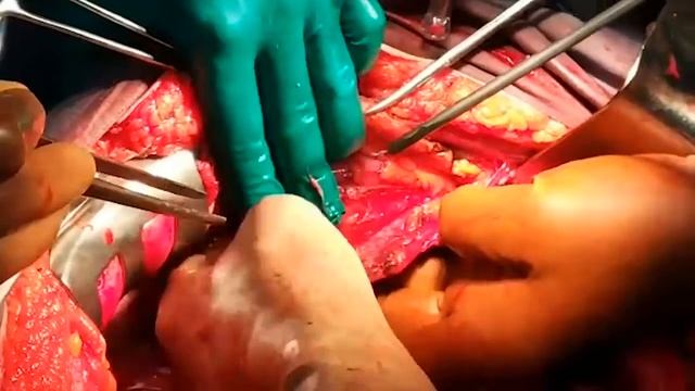 JPlasma | Peritoneal Stripping смотреть онлайн