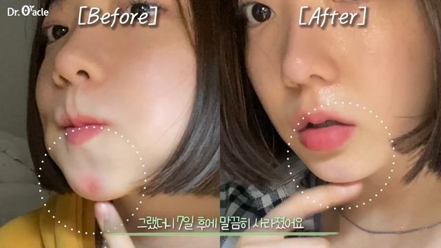 [비포애프터] 7일만에!! 피부 진정 시키는 법 "진정+수분+항산화케어"까지!? смотреть онлайн