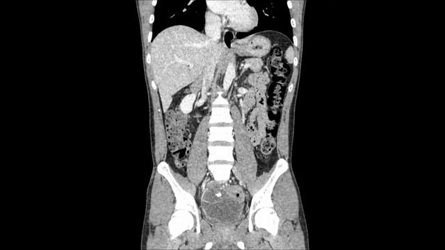 lymph node metastasis from sigma colon carcinoma смотреть онлайн