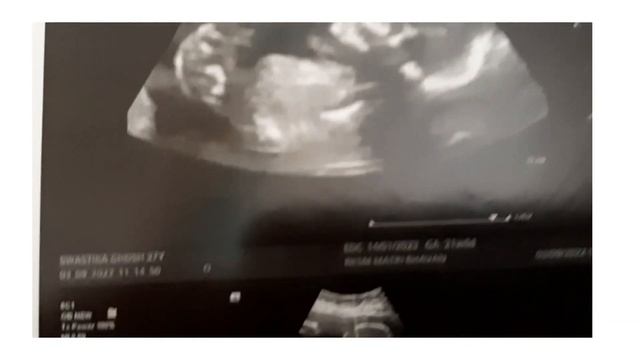 report se Jane baby boy h Ya girl//level 2 ultrasound//ANAMALY SCAN AT 19TH WEEKS смотреть онлайн