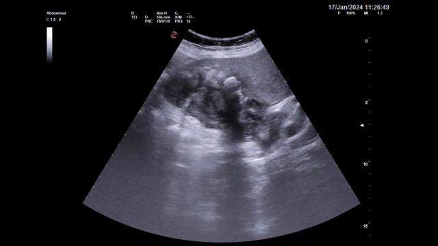 Рак жёлчного пузыря. Gallbladder cancer. Tulžies pūslės vėžys смотреть онлайн
