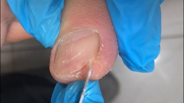 Pedicure Tutorial: The Uncompressed Ingrown Toenail Trim Process! смотреть онлайн