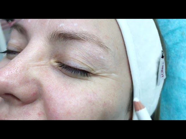 Ботулинотерапия межбровья. смотреть онлайн