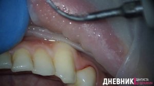 ультразвуковая чистка зубов , удаление зубного камня и налета под микроскопом #стоматология #пломба
