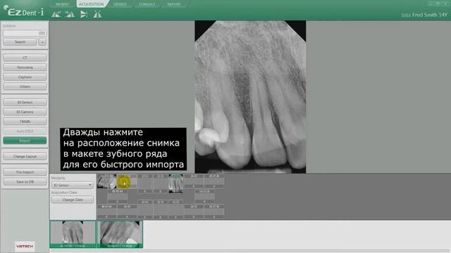 07 Импорт интраоральных снимков в программе EzDent-i смотреть онлайн