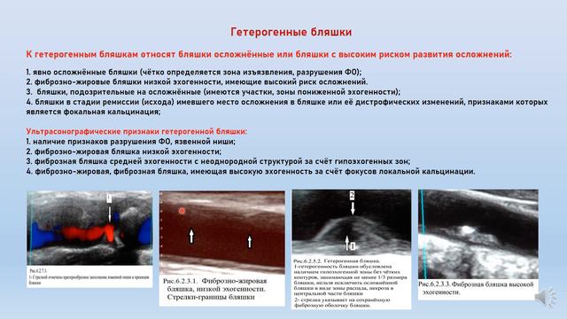 Выпуск 5 УЗДГ атеросклероза, часть 3 смотреть онлайн