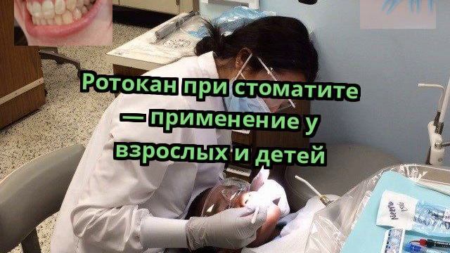 Ротокан при стоматите — применение у взрослых и детей смотреть онлайн