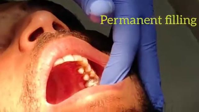 Root Canal Treatment смотреть онлайн