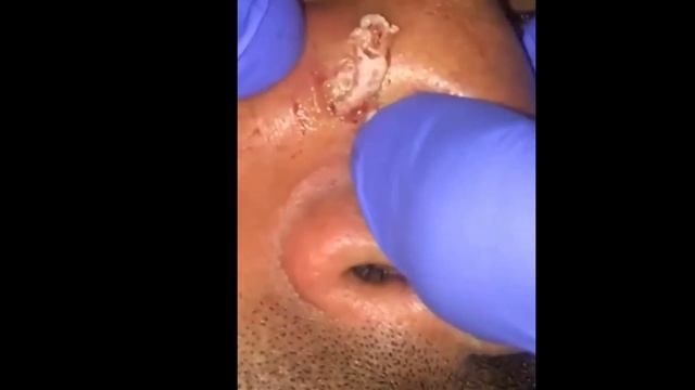 Удаление черных точек 2022 EP08 смотреть онлайн