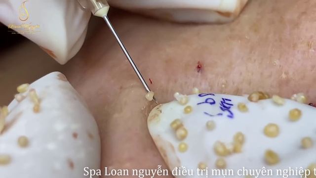 PEARL ACNE (42 minute) 68 | Spa Loan Nguyen смотреть онлайн