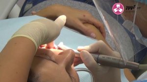Лечение и чистка каналов зуба в стоматологии Зууб в Царицыно