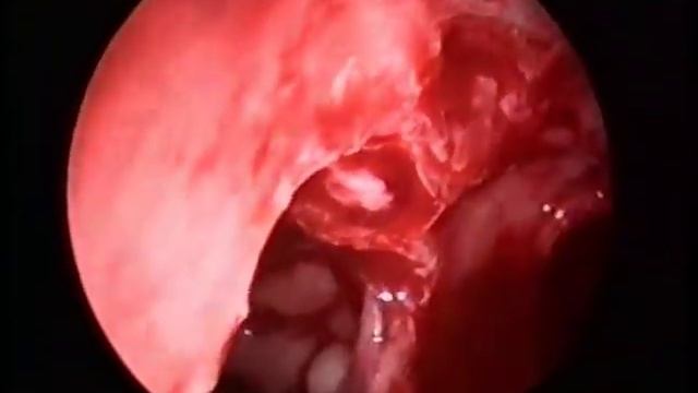 Chronic Sinusitis - Complication Of Sinus Lift ESS And Closure Of OAF With Buccal Fat Pad