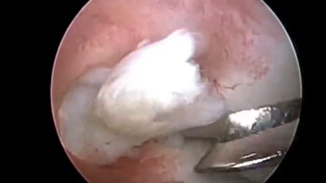 Резекция мениска