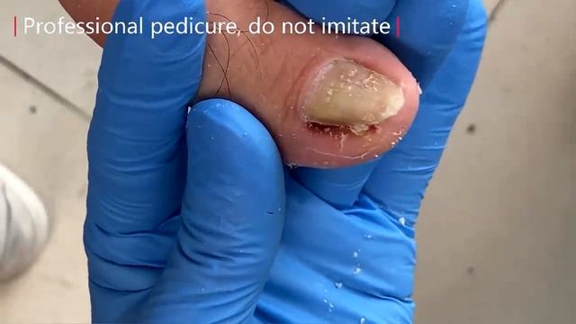 Pedicure Tutorial: Remove Dead Skin Under Toenails【Xue Yidao】 смотреть онлайн