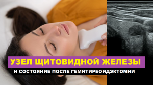 Узел щитовидной железы и состояние после правосторонней гемитиреоидэктомии