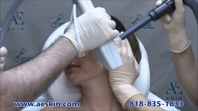 Forever Young BBL IPL Photofacial demonstration 27 - A E Skin - Encino, CA - 818-835-1833 смотреть онлайн